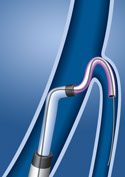 The LVI is easily advanced over the wire and vein selector into the target vein.