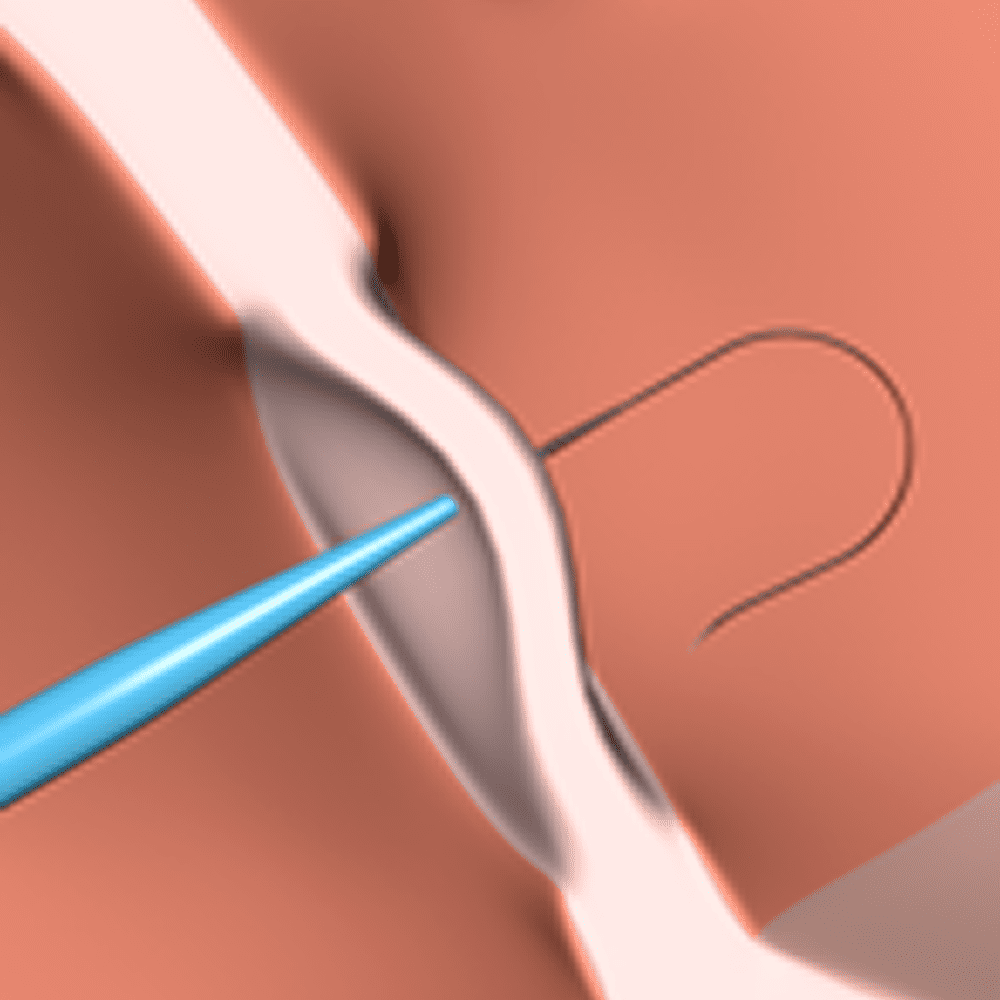 Surgical stitching with needle and thread.