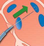 Advancing SafeSept into the Left Atrium