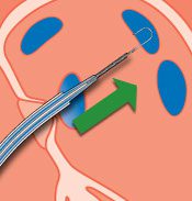 Needle, Dilator and Introducer Tracking over SafeSept